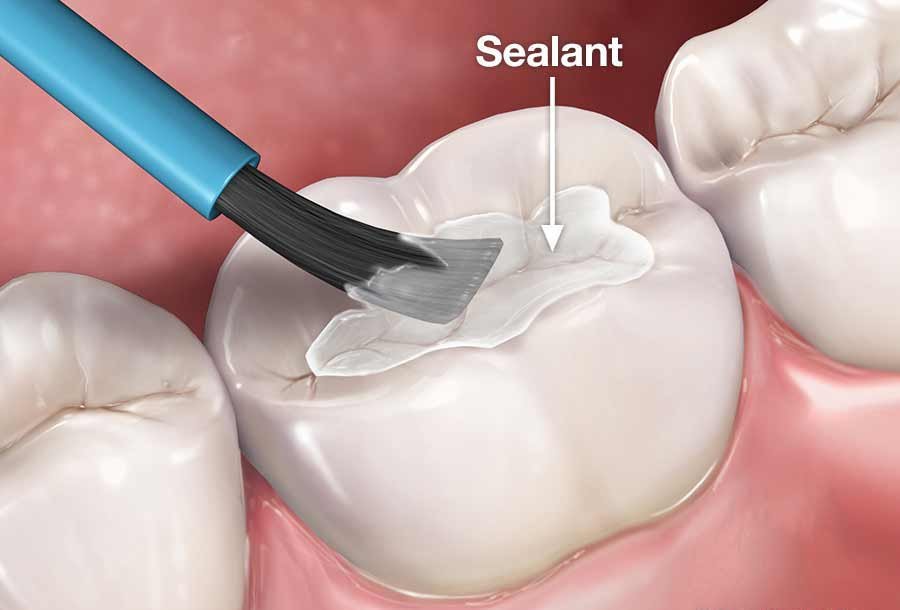 Pit & Fissure Sealant